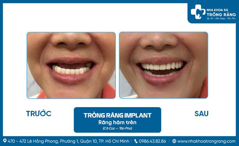 Trồng răng implant ở người lớn tuổi