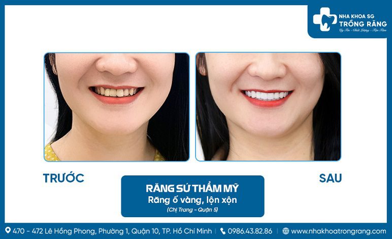 Khách hàng làm răng sứ sau khi sửa mũi