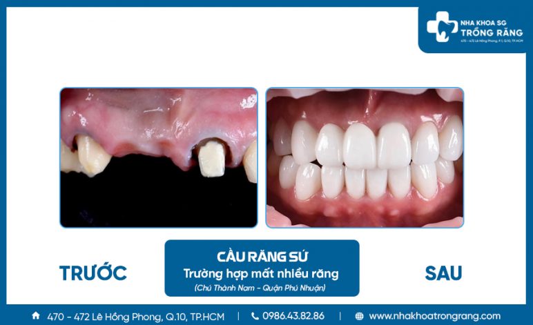 Làm cầu răng sứ cho người cao tuổi