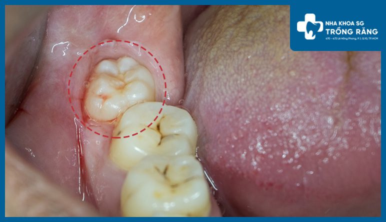 Nhức răng do mọc răng khôn