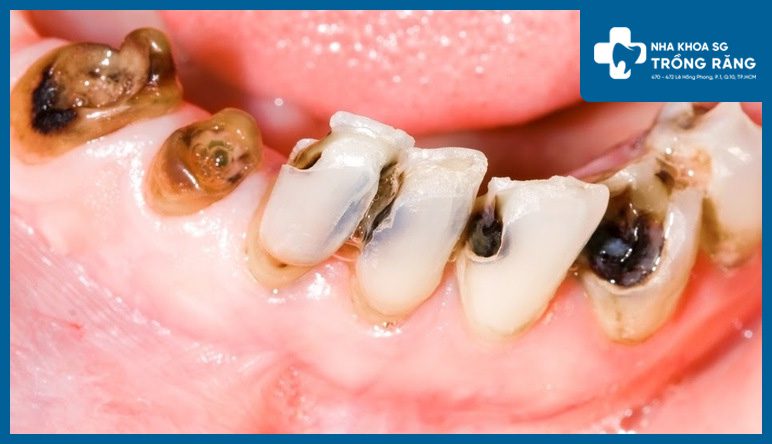 Nhức răng do sâu răng