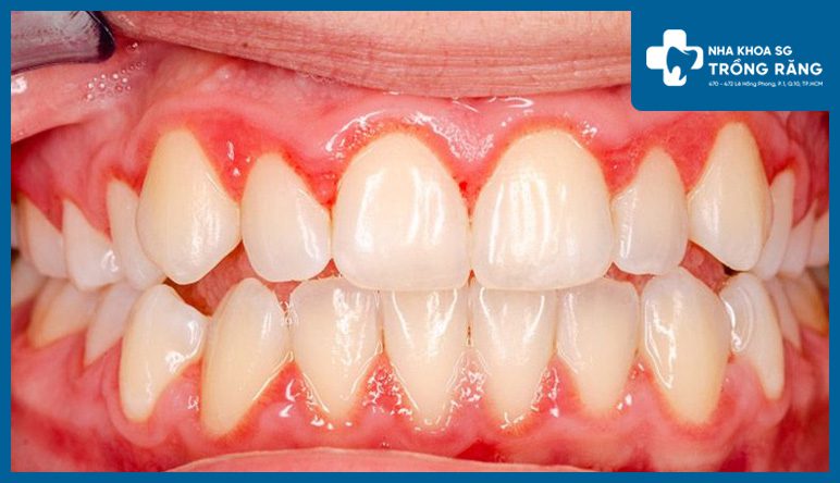 Nhức răng do viêm nướu