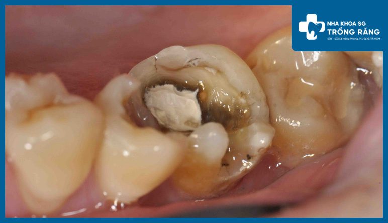 Nhức răng do viêm tủy răng