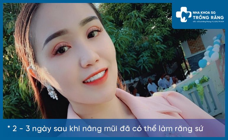 Thời gian làm răng sứ sau khi sửa mũi