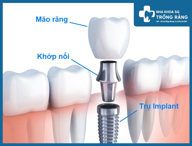 Cấu tạo răng implant