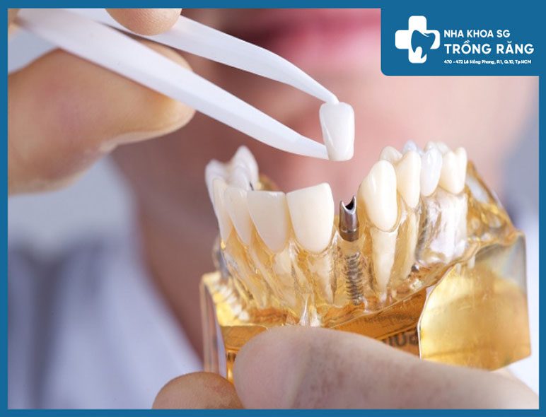 Thời gian trồng răng implant mất bao lâu