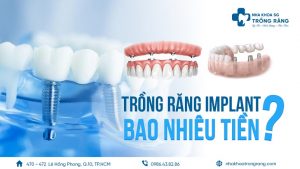trồng răng implant giá bao nhiêu