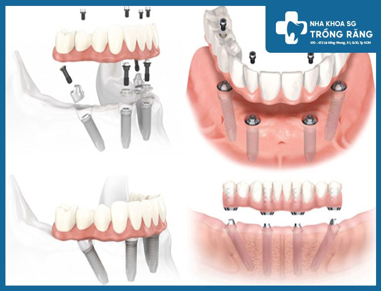 Hàm giả tháo lắp trên trụ Implant