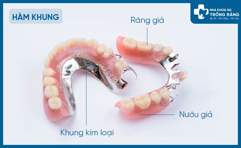 Hàm khung răng giả tháo lắp bằng kim loại