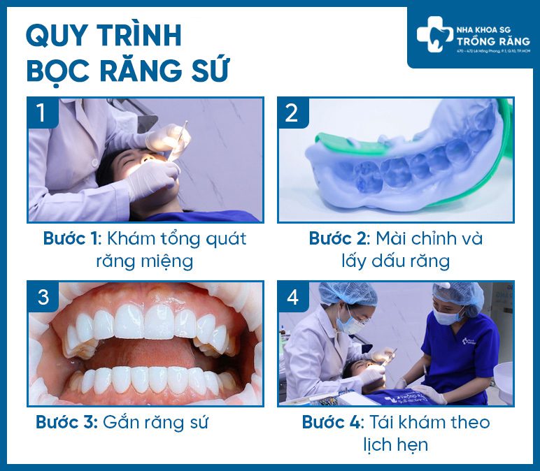 Quy trình bọc răng sứ