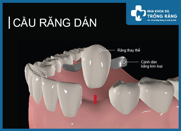 cầu răng dán