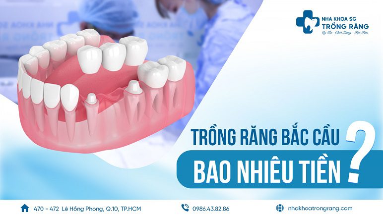 cầu răng sứ giá bao nhiêu