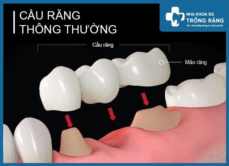 Cầu răng sứ thông thường