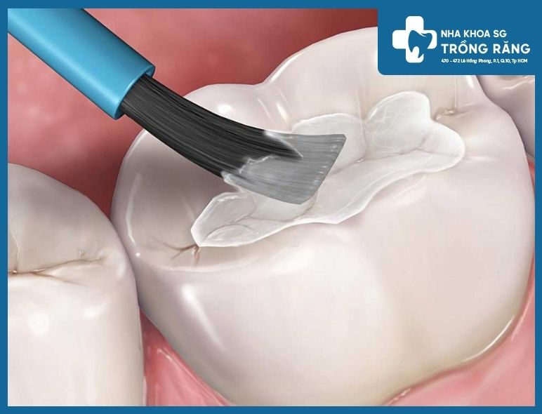 hinh anh tram rang khong can mai