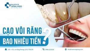 lấy vôi răng bao nhiêu tiền