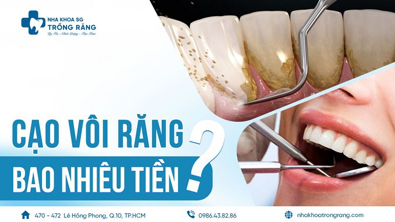 lấy vôi răng bao nhiêu tiền lấy vôi răng bao nhiêu tiền