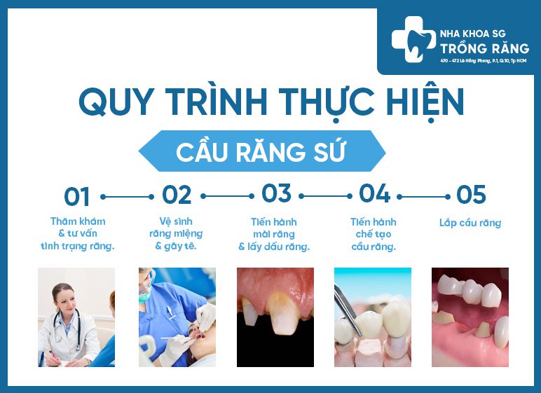 quy trình làm cầu răng sứ