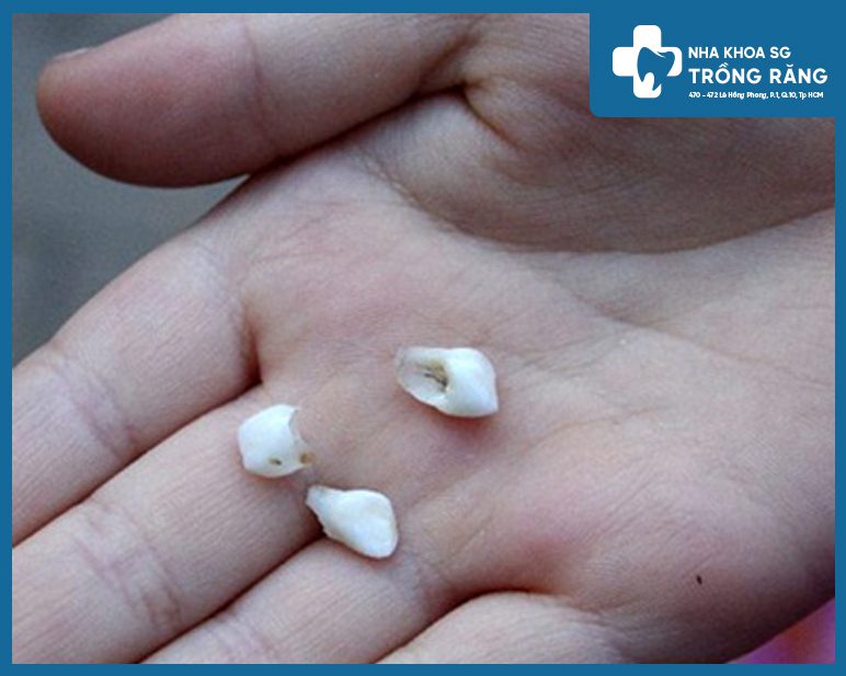 răng sứ bị rớt