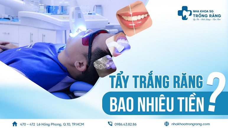 tẩy trắng răng giá bao nhiêu