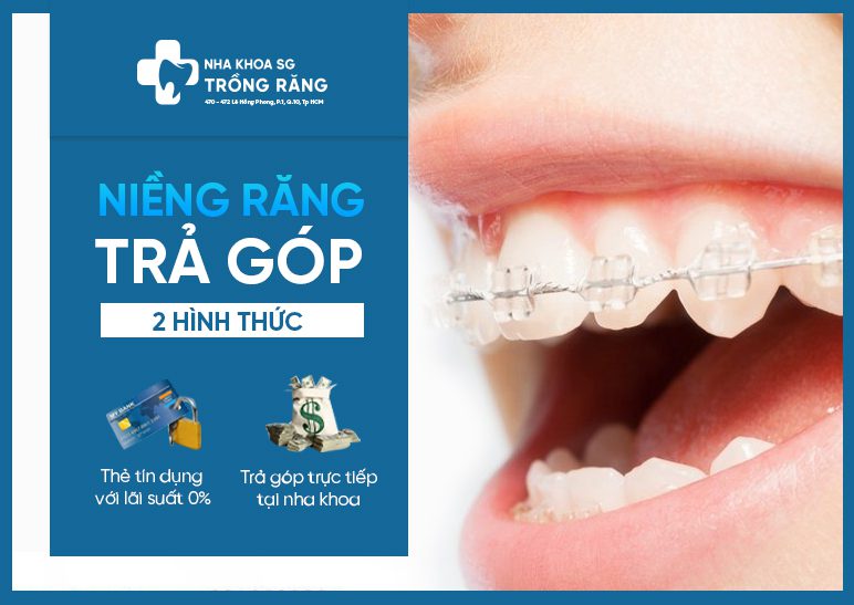 thủ tục niềng răng trả góp