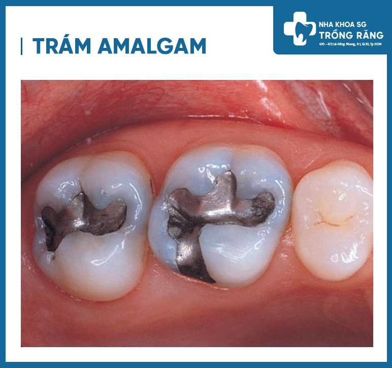 trám răng amalgam