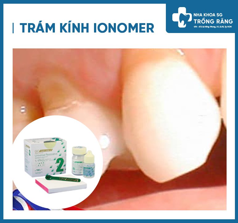 trám răng kính ionomer