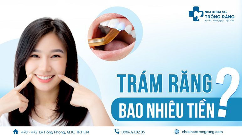 trám răng bao nhiêu tiền