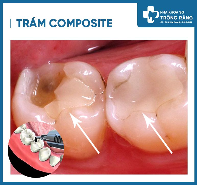 trám răng composite