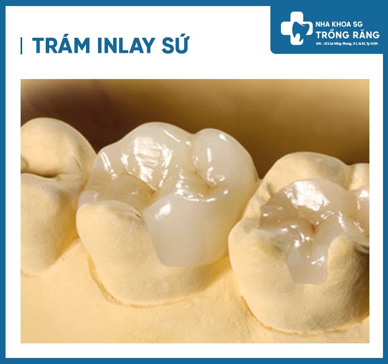 trám răng inlay sứ