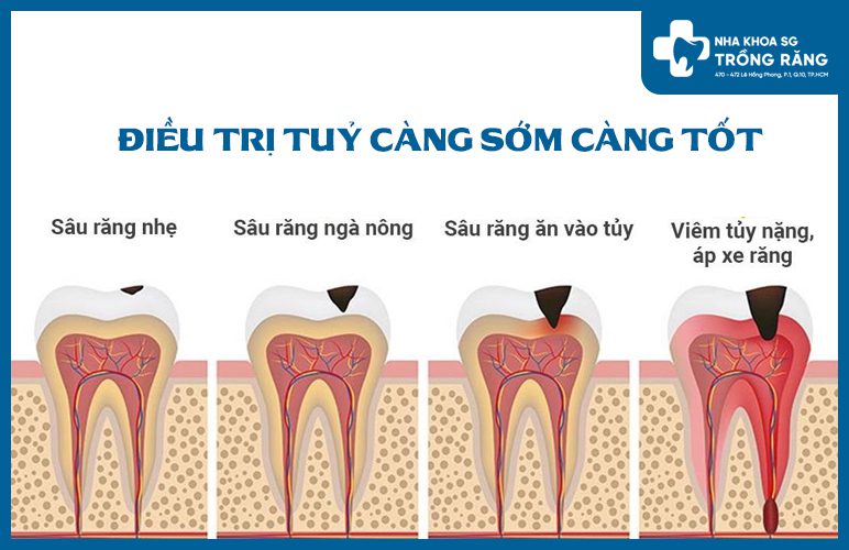 cách trường hợp cần lấy tủy răng