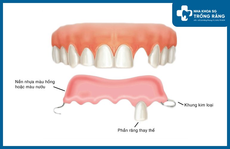 cấu tạo răng giả tháo lắp 1 chiếc