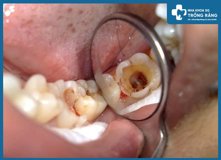 khi nào nên lấy tủy răng