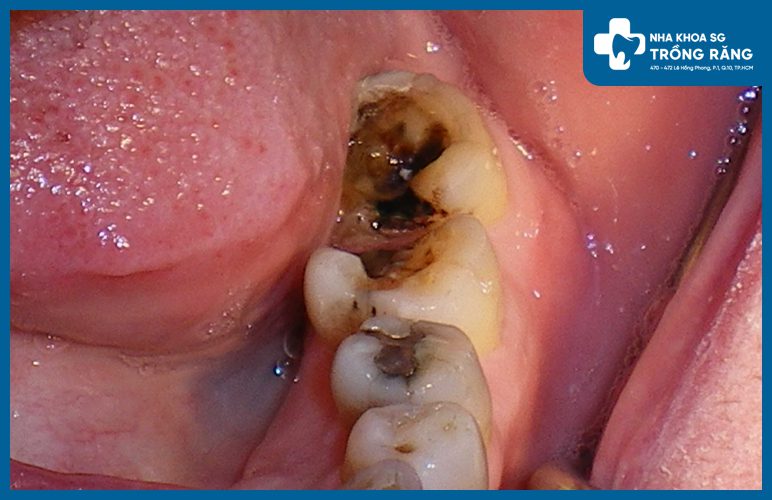 nguyên nhân đau răng hàm nguyên nhân đau răng hàm