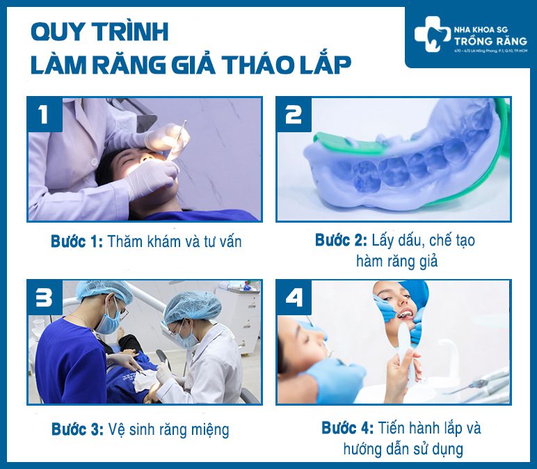 quy trình làm răng giả tháo lắp