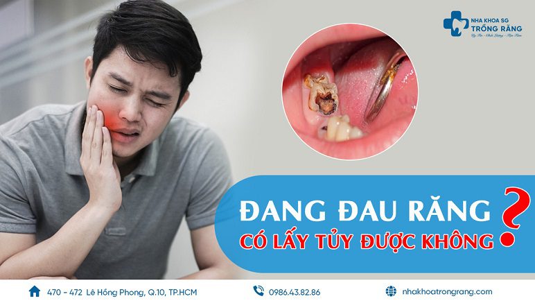 răng đang đau có lấy tủy được không