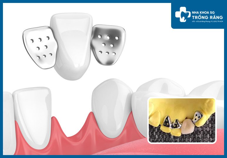 răng giả tạm thời cánh dán