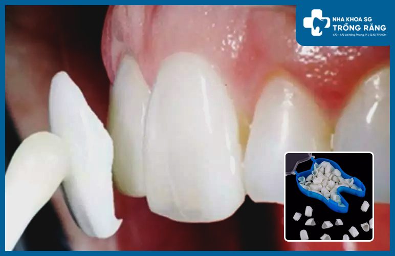 răng giả tạm thời khi làm răng sứ