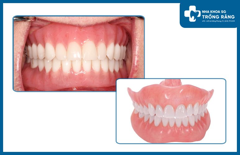 răng giả tháo lắp toàn phần