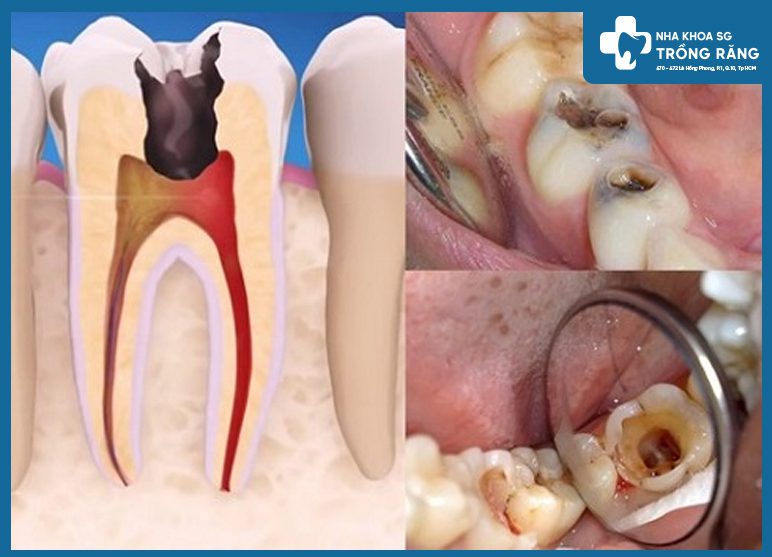 tủy răng bị viêm tổn thương