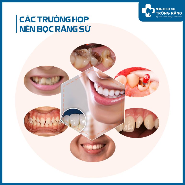 các trường hợp nên bọc răng sứ