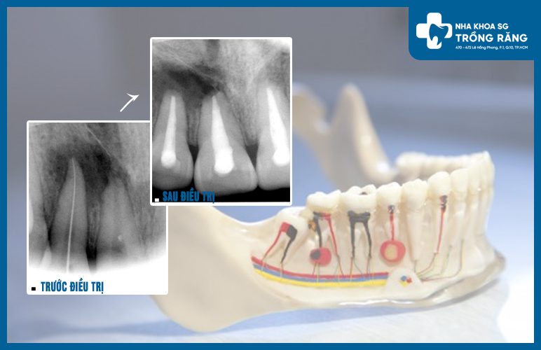 chuẩn đoán viêm chóp răng