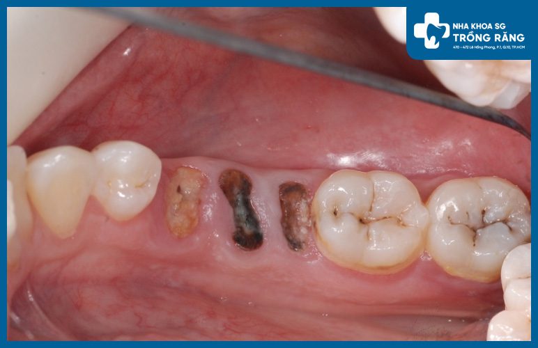 dau rang sung ma do viem tuy đau răng sưng má do viêm tủy