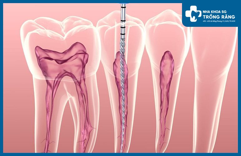 điều trị răng sâu vào tủy