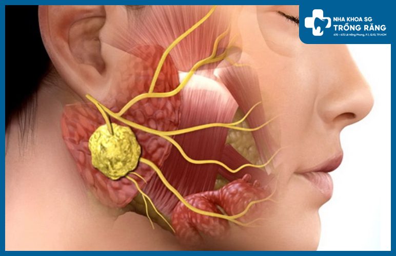 hiện tượng u răng sưng má