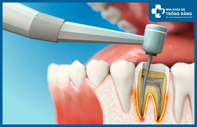 hình ảnh lấy tủy răng bằng máy