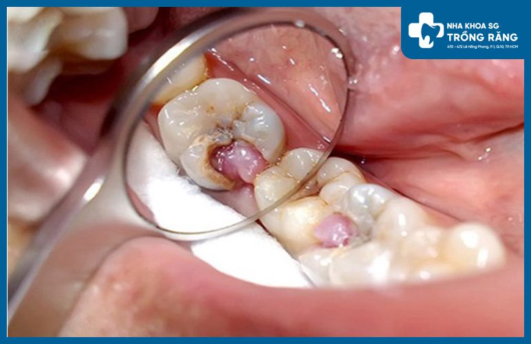 hinh anh rang bi ton thuong viem tuy loi thit hình ảnh răng bị tổn thương, viêm tủy, lồi thịt