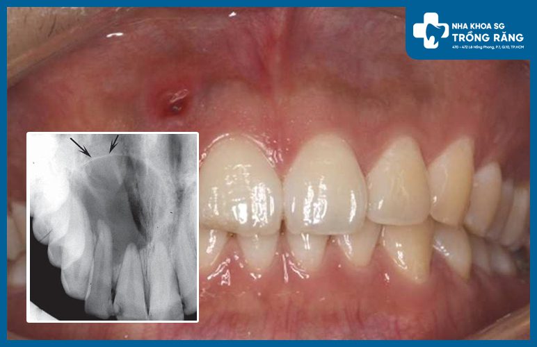 hình ảnh viêm chóp răng