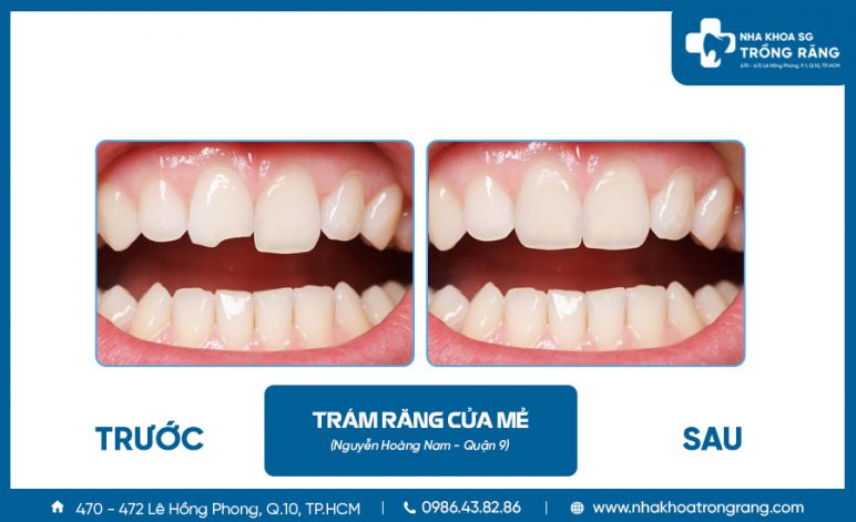 kết quả trám răng cửa bị mẻ