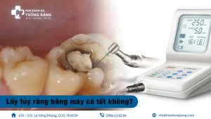 lấy tủy răng bằng máy