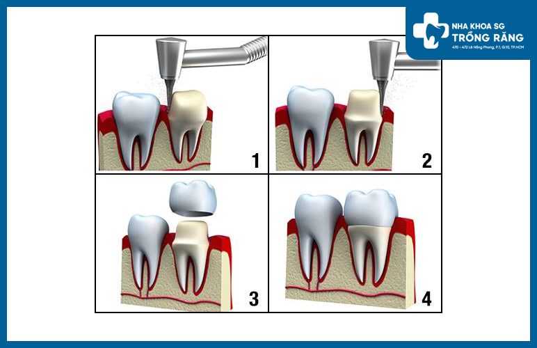 quy trình bọc răng sứ 1 chiếc